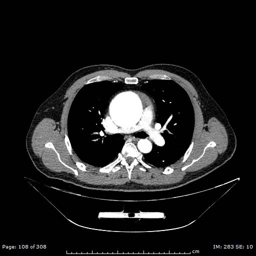 File:Ascending aortic aneurysm (Radiopaedia 50086-55404 A 31).jpg