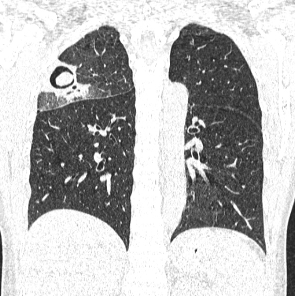 File:Aspergilloma (Radiopaedia 26223-26347 Coronal lung window 35).jpg