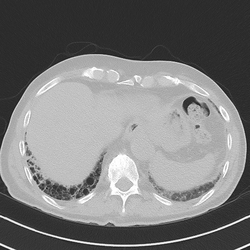 Aspergilloma on background pulmonary fibrosis (Radiopaedia 60942-68757 A 47).jpg