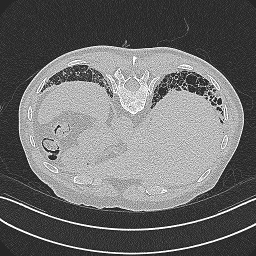File:Aspergilloma on background pulmonary fibrosis (Radiopaedia 60942-68757 Axial lung window 32).jpg