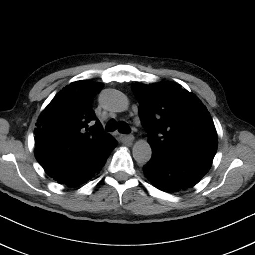 Aspergilloma on background pulmonary fibrosis (Radiopaedia 60942-68757 Axial non-contrast 22).jpg