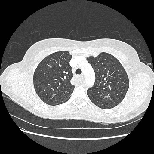 Aspiration pneumonia secondary to laparoscopic banding (Radiopaedia 18345-18183 lung window 29).jpg
