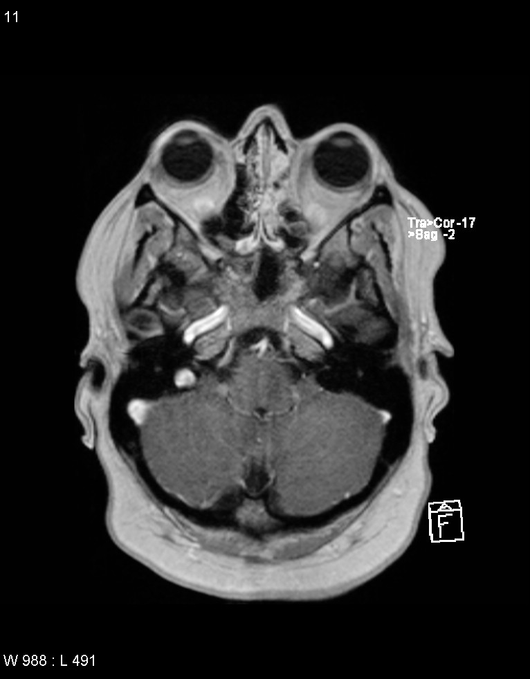 Astroblastoma (Radiopaedia 39792-42217 Axial T1 C+ 10).jpg