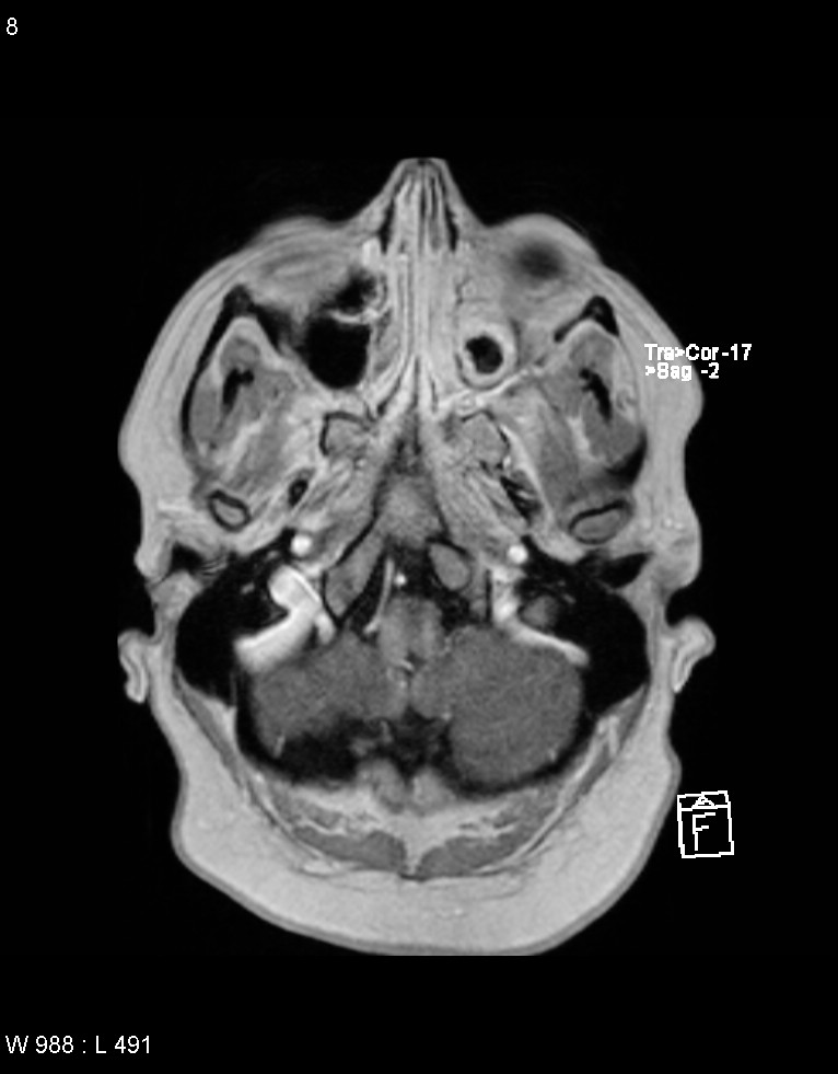 Astroblastoma (Radiopaedia 39792-42217 Axial T1 C+ 7).jpg