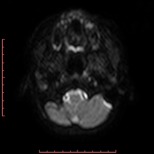 Astroblastoma (Radiopaedia 74287-85162 Axial DWI 1).jpg