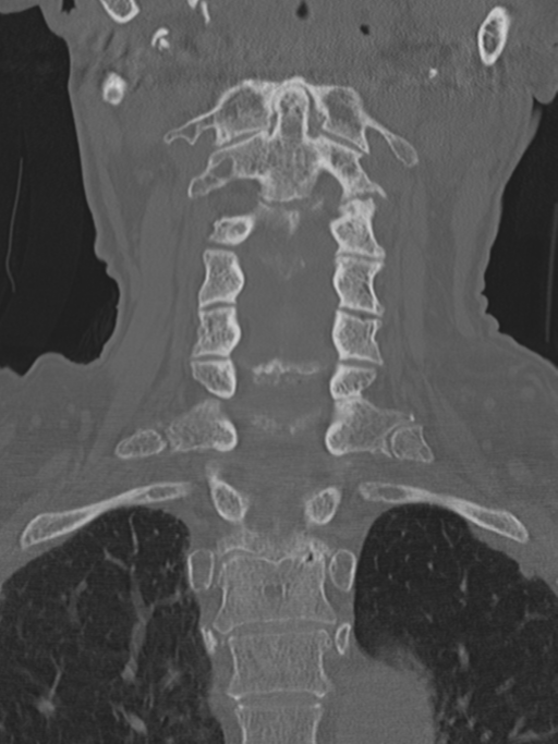 Atlanto-axial subluxation (Radiopaedia 36610-38176 Coronal bone window 24).png