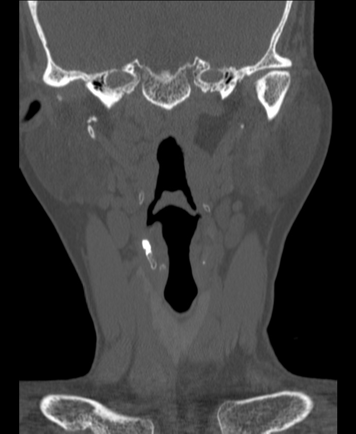 Atlanto-occipital assimilation with basilar invagination (Radiopaedia 70122-80188 Coronal bone window 18).jpg