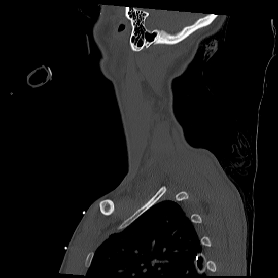 Atlanto-occipital dissociation (Traynelis type 1), C2 teardrop fracture, C6-7 facet joint dislocation (Radiopaedia 87655-104061 Sagittal bone window 63).jpg