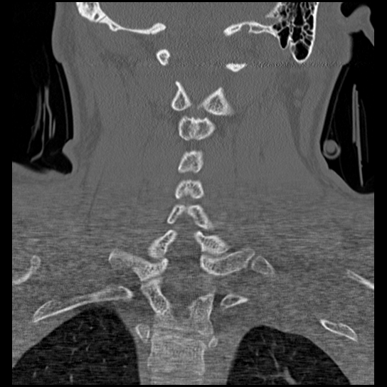 Atlanto-occipital dissociation injury (Radiopaedia 29274-29698 Coronal bone window 17).png
