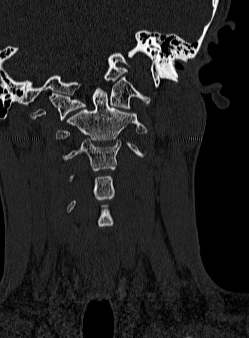 Atlantoaxial subluxation (Radiopaedia 44681-48450 Coronal bone window 30).jpg