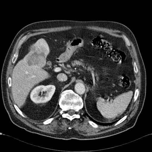 Atypical hepatocellular carcinoma (Radiopaedia 41744-44698 B 25).jpg