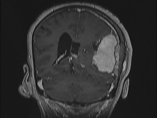 File:Atypical meningioma (Radiopaedia 62985-71406 Coronal T1 C+ 83).jpg