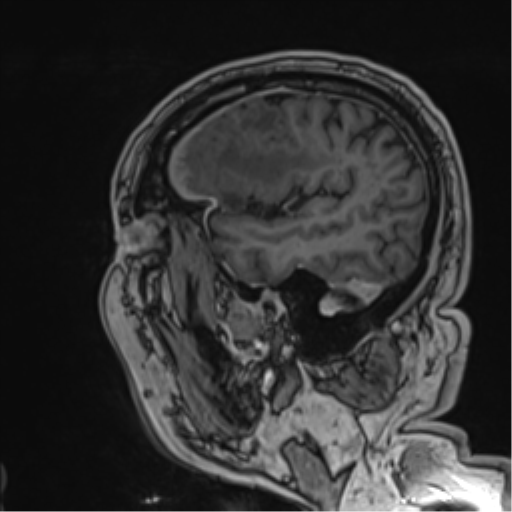 Atypical meningioma (WHO grade II) with brain invasion (Radiopaedia 57767-64729 Sagittal T1 C+ 52).png