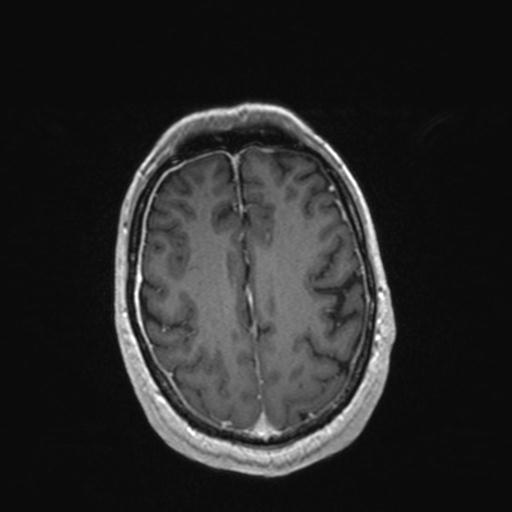 Atypical meningioma (grade II) - en plaque (Radiopaedia 29633-30147 Axial T1 C+ 139).jpg