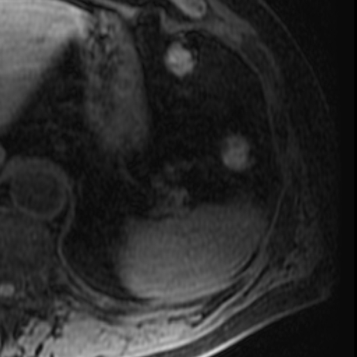 File:Atypical renal cyst on MRI (Radiopaedia 17349-17046 Axial T1 fat sat 1).jpg