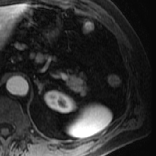 File:Atypical renal cyst on MRI (Radiopaedia 17349-17046 C 4).jpg