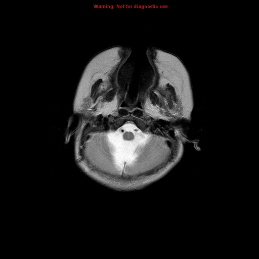 File:Atypical teratoid rhabdoid tumor (Radiopaedia 10712-11183 Axial T2 16).jpg