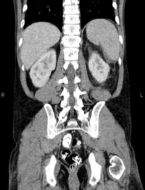 Autoimmune pancreatitis (Radiopaedia 84925-100431 D 47).jpg