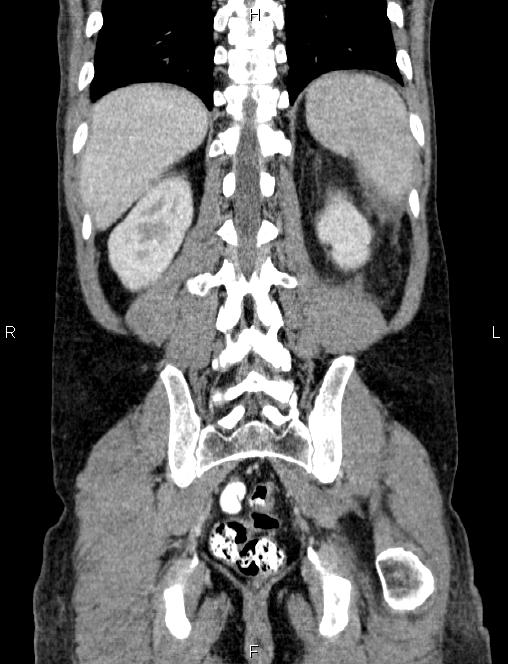 Autoimmune pancreatitis (Radiopaedia 84925-100431 D 49).jpg