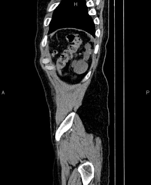 Autosomal dominant polycystic kidney disease (Radiopaedia 87830-104287 C 87).jpg