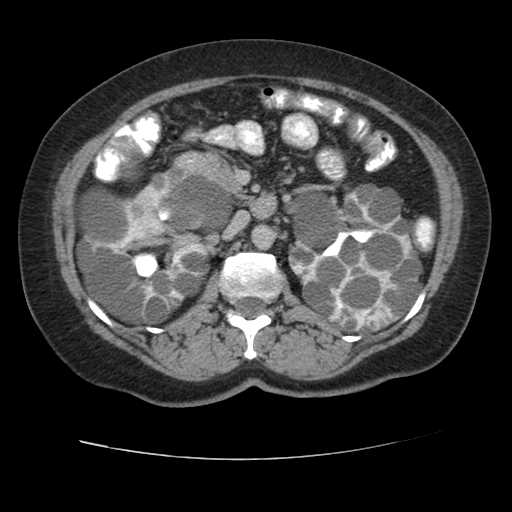 Autosomal dominant polycystic kidney disease with hepatic involvement (Radiopaedia 32693-33662 C 33).jpg