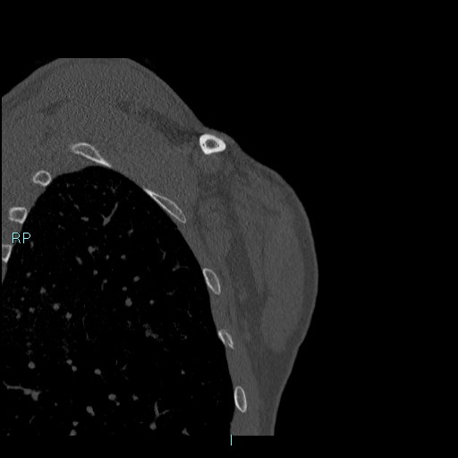 Avascular necrosis after fracture dislocations of the proximal humerus (Radiopaedia 88078-104655 Coronal bone window 124).jpg