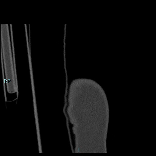 Avascular necrosis after fracture dislocations of the proximal humerus (Radiopaedia 88078-104655 Coronal bone window 9).jpg