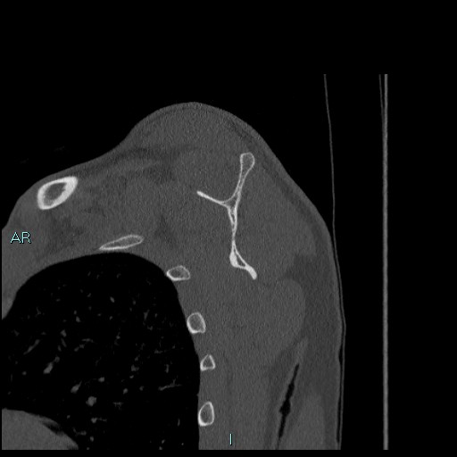 Avascular necrosis after fracture dislocations of the proximal humerus (Radiopaedia 88078-104655 Sagittal bone window 47).jpg