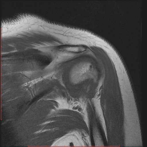 File:Avulsion fracture - greater tuberosity of humerus (Radiopaedia 25457-25703 Coronal T1 10).jpg
