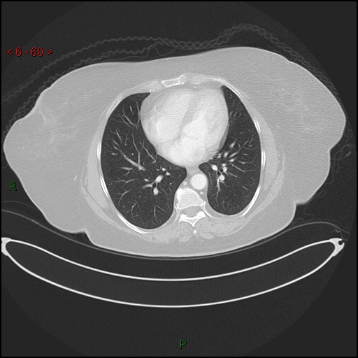File:Azygos fissure and lobe (Radiopaedia 47620-52278 Axial lung window 60).jpg
