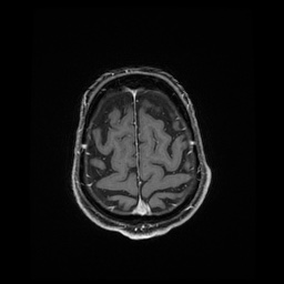 Balo concentric sclerosis (Radiopaedia 53875-59982 Axial LAVA C+ 224).jpg