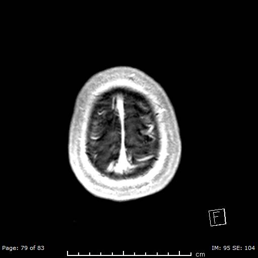 Balo concentric sclerosis (Radiopaedia 61637-69636 Axial T1 C+ 79).jpg