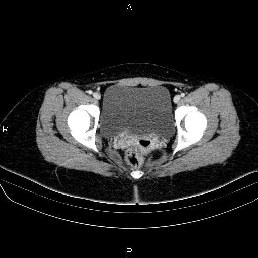 File:Bartholin gland cyst (Radiopaedia 62635-70930 Axial Post contrast 63).jpg