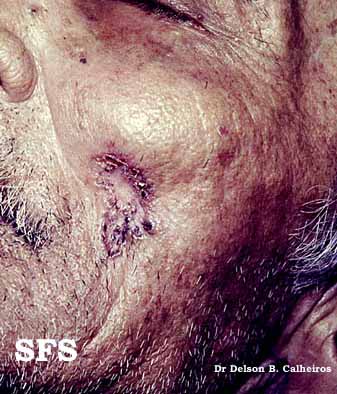 Basal Cell Carcinoma (Dermatology Atlas 5).jpg