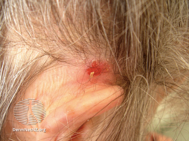 File:Basal cell carcinoma affecting the face (DermNet NZ lesions-bcc-face-0812).jpg