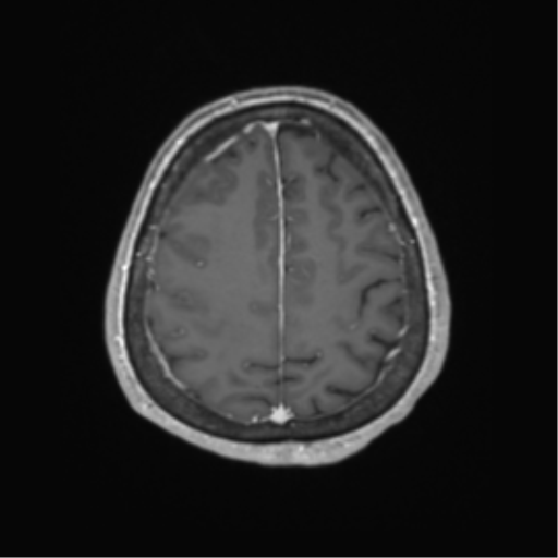 Basal ganglia metastasis (Radiopaedia 78928-91828 Axial T1 C+ 59).png