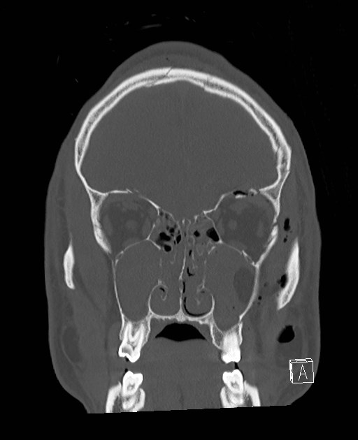 Base of skull fracture with bilateral Le Fort fractures (Radiopaedia 47094-51638 Coronal bone window 73).jpg