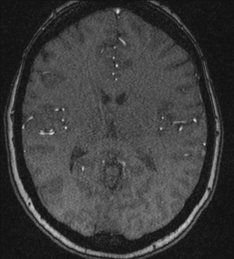 Basilar tip aneurysm (Radiopaedia 26504-26632 MRA 140).jpg