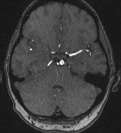 Basilar tip aneurysm (Radiopaedia 26504-26632 MRA 76).jpg