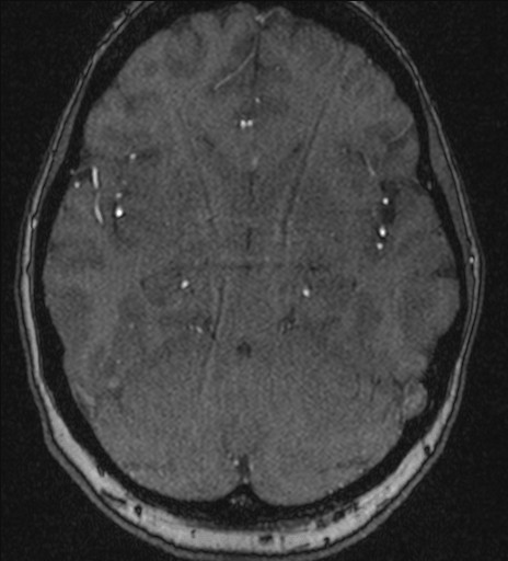 Basilar tip aneurysm (Radiopaedia 26504-26632 MRA 94).jpg