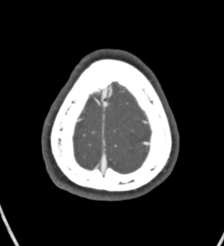 Basilar tip aneurysm with coiling (Radiopaedia 53912-60086 A 138).jpg