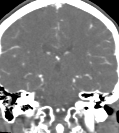 File:Basilar tip aneurysm with coiling (Radiopaedia 53912-60086 B 89).jpg