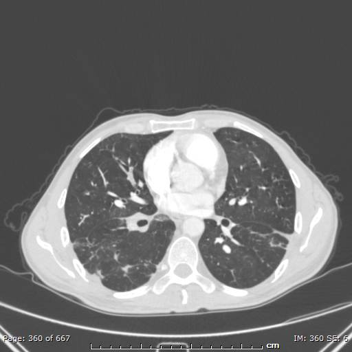 File:Behçet disease (Radiopaedia 44247-47889 Axial lung window 47).jpg