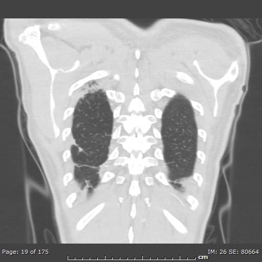 Behçet disease (Radiopaedia 44247-47889 Coronal lung window 1).jpg