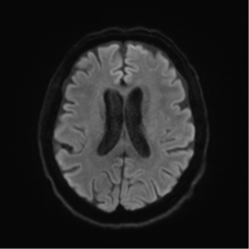 Behavioral variant frontotemporal dementia and late onset schizophrenia (Radiopaedia 52197-58083 Axial DTI Trace W 43).png