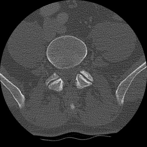 Benign post-traumatic pseudopneumoperitoneum (Radiopaedia 71199-81495 Axial bone window 263).jpg