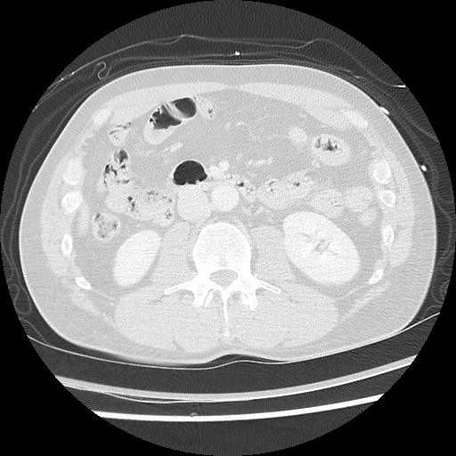 Benign post-traumatic pseudopneumoperitoneum (Radiopaedia 71199-81495 Axial lung window 87).jpg