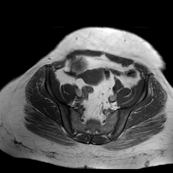 File:Benign seromucinous cystadenoma of the ovary (Radiopaedia 71065-81300 Axial T1 12).jpg