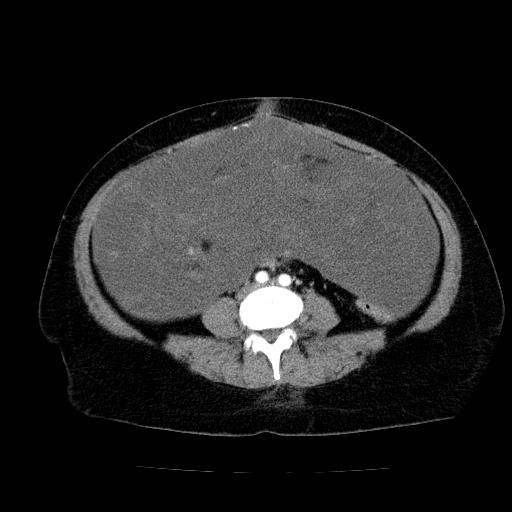 Benign spindle cell tumor - abdominopelvic (Radiopaedia 61300-69212 A 38).jpg