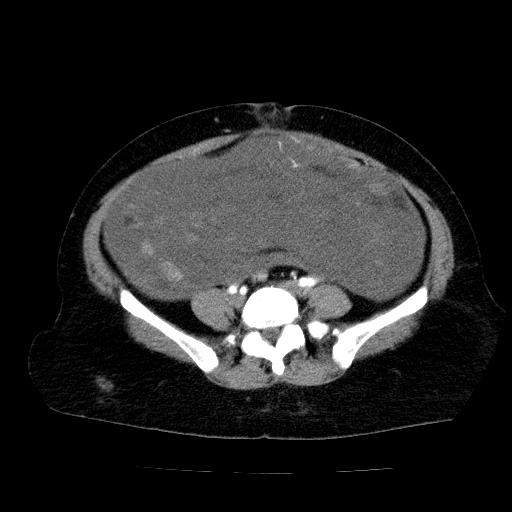 Benign spindle cell tumor - abdominopelvic (Radiopaedia 61300-69212 A 42).jpg